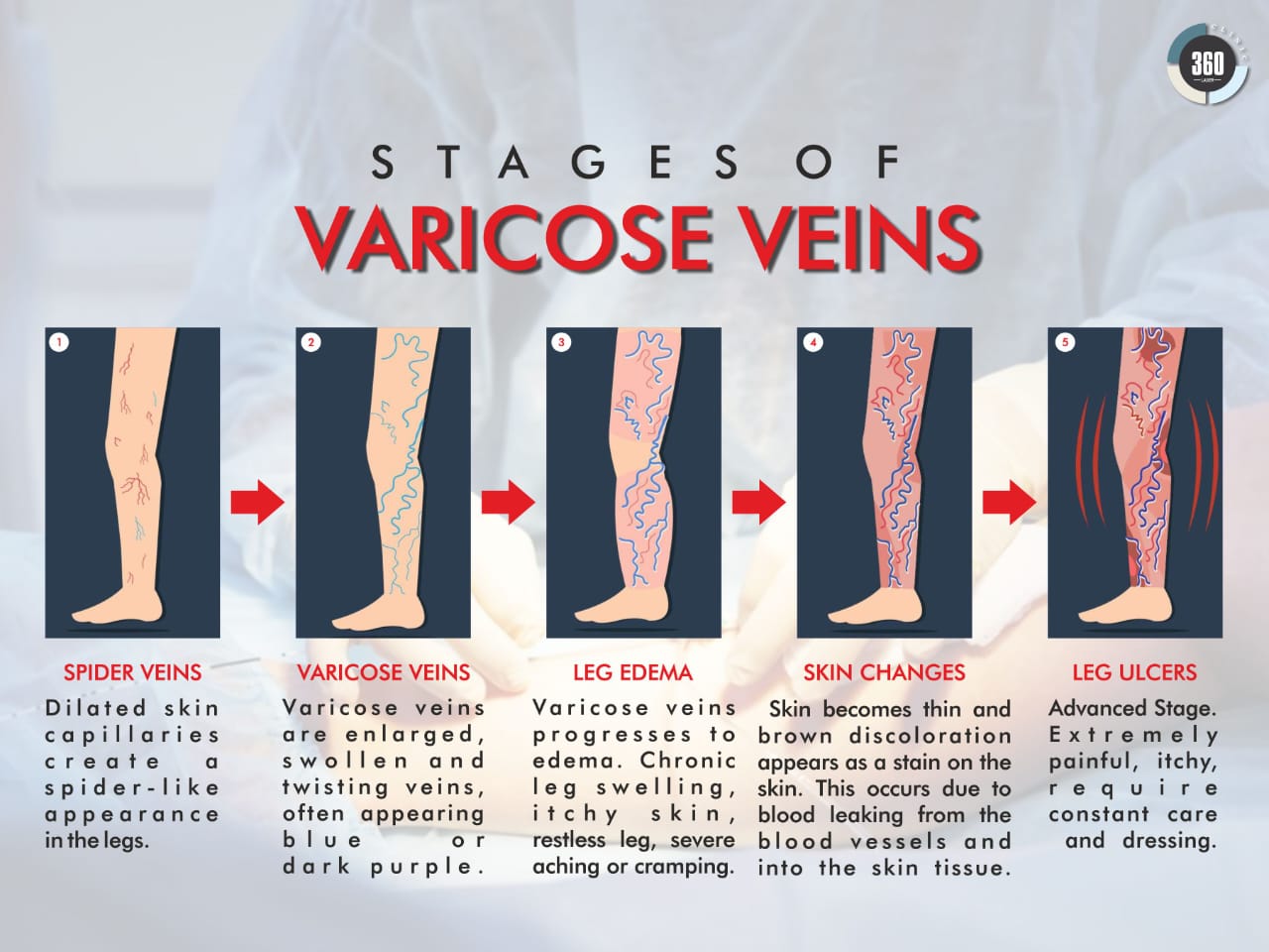 Best Varicose Veins Treatment in Delhi Laser 360 Clinic